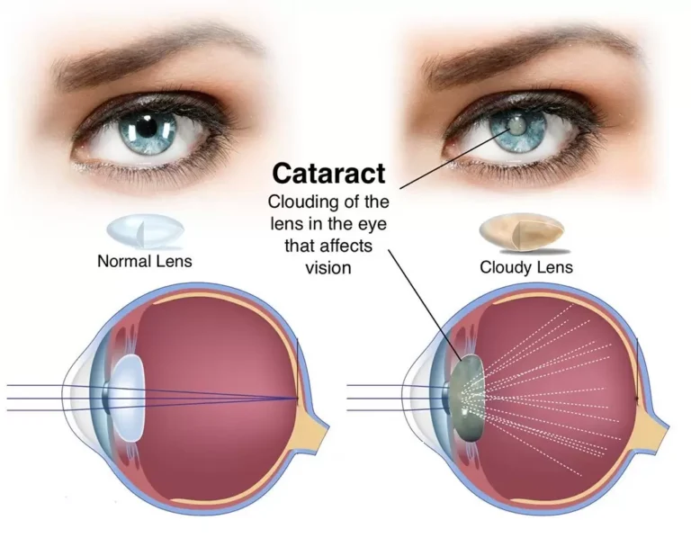 When to Consider Cataract Surgery